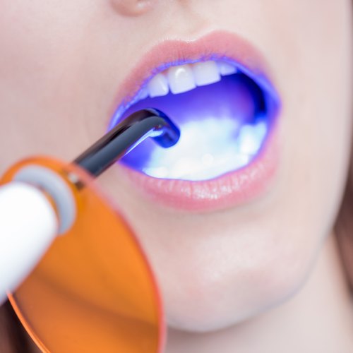 Blanqueamiento Dental con Luz LED