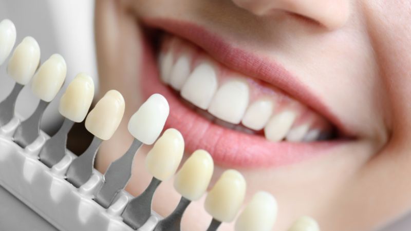 Blanqueamiento dental
