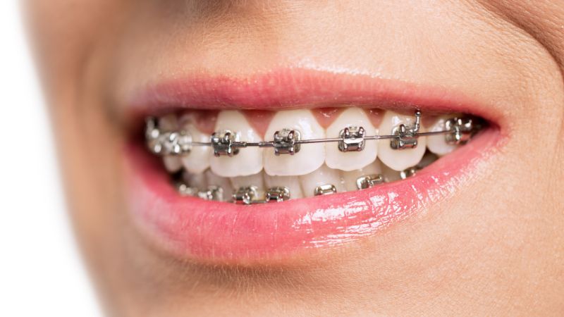 Ortodoncia invisible vs. brackets tradicionales