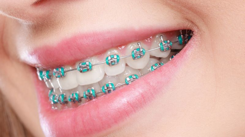 Ortodoncia invisible vs. brackets tradicionales