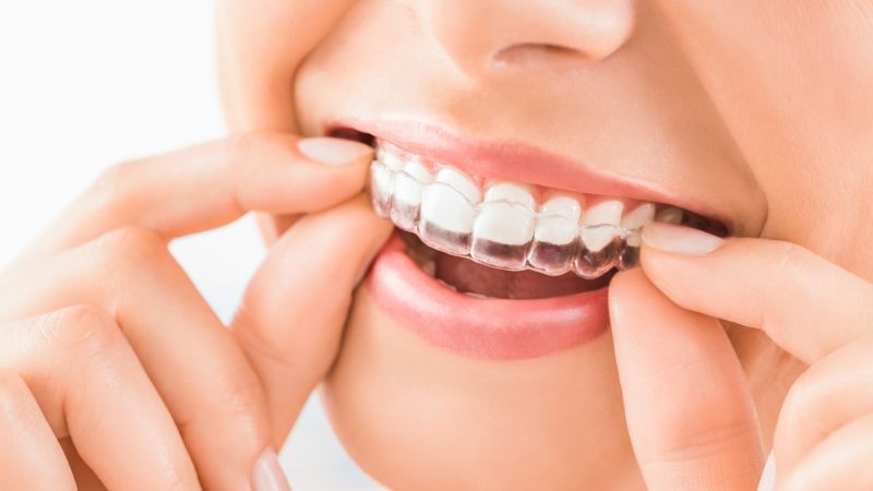 Ortodoncia invisible vs. brackets tradicionales