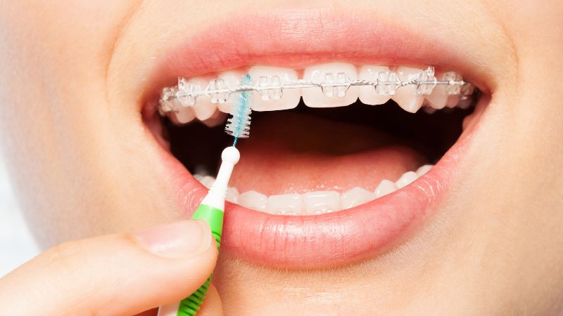 Hilo dental vs. cepillos interdentales