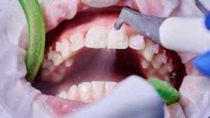 Limpieza dental profesional