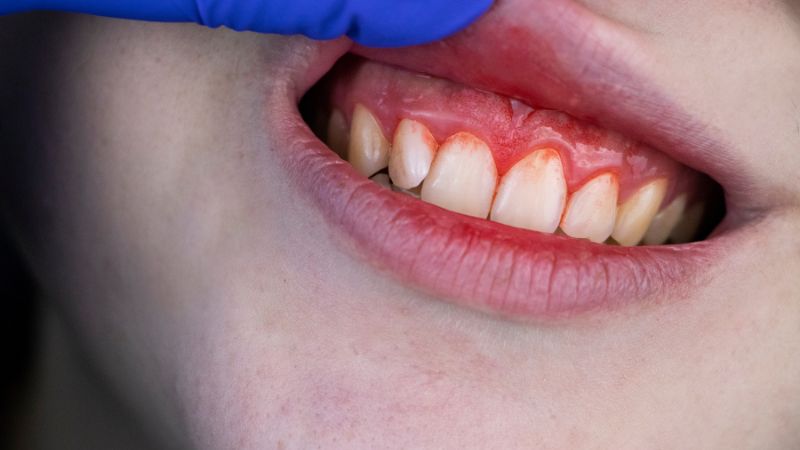 Periodoncia - Barberà del Vallès