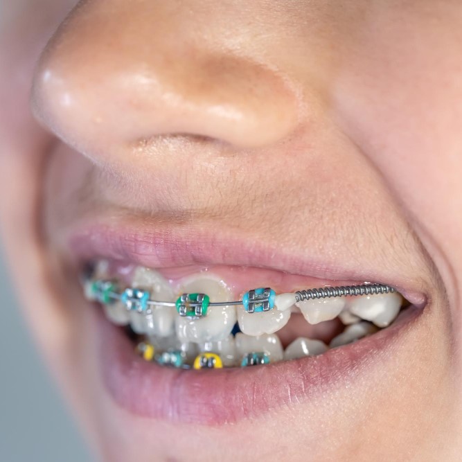 joven con brackets y coil