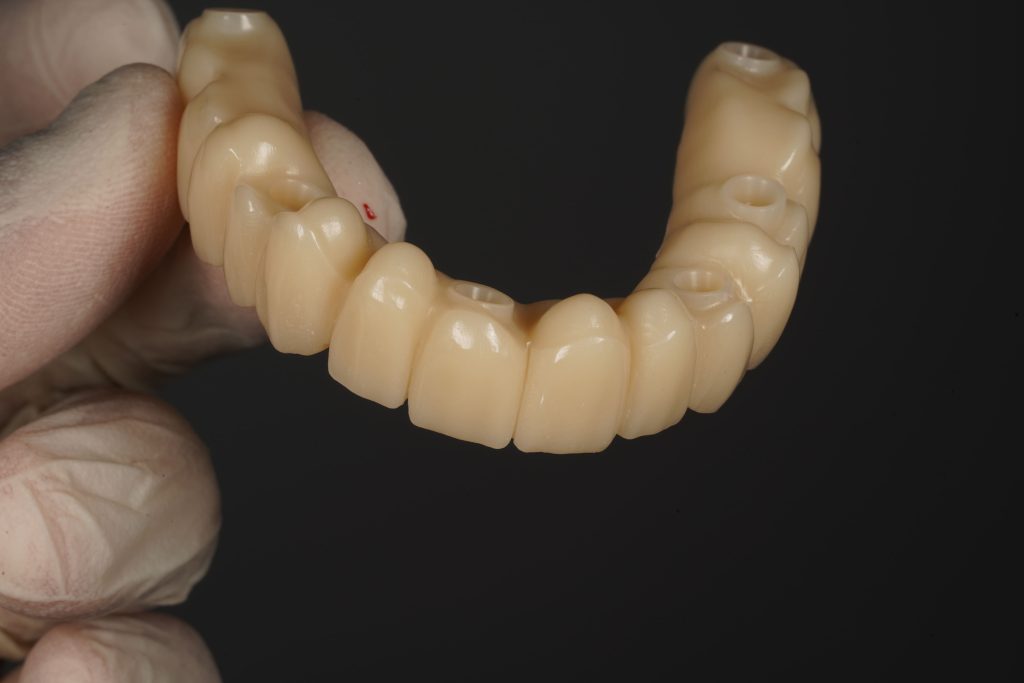 Prótesis dental colocada sobre implantes