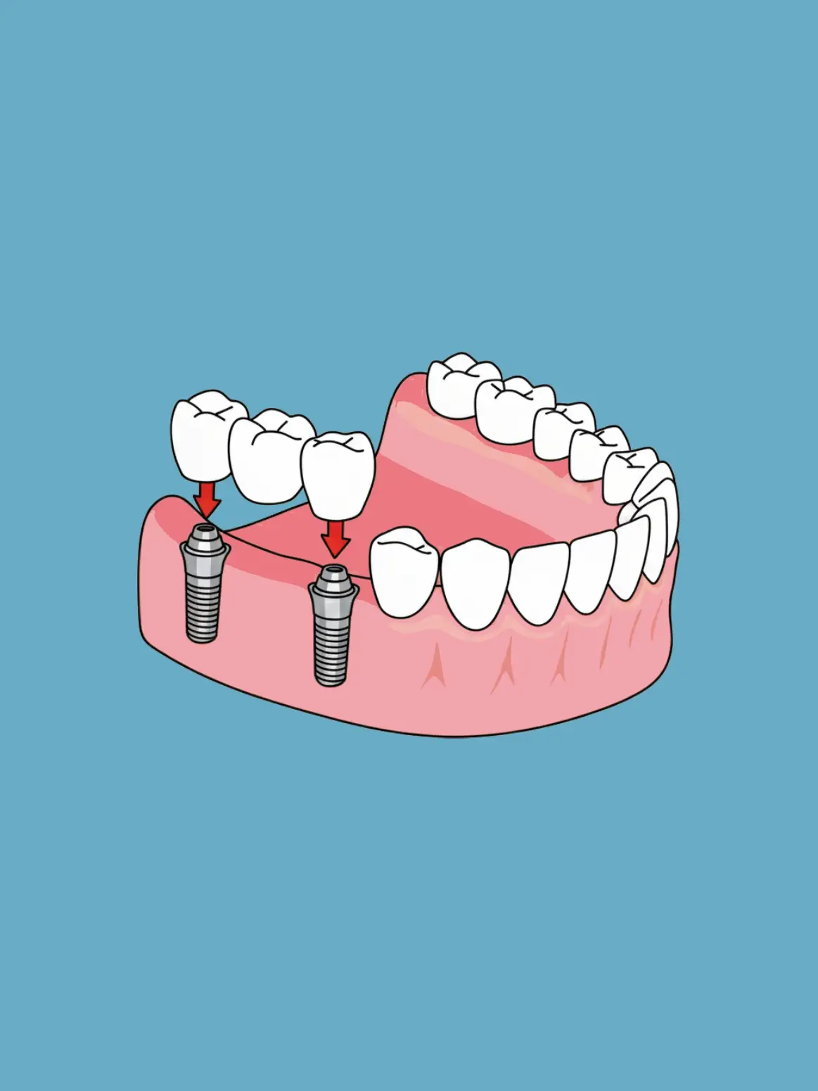 Rehabilitación con prótesis fija