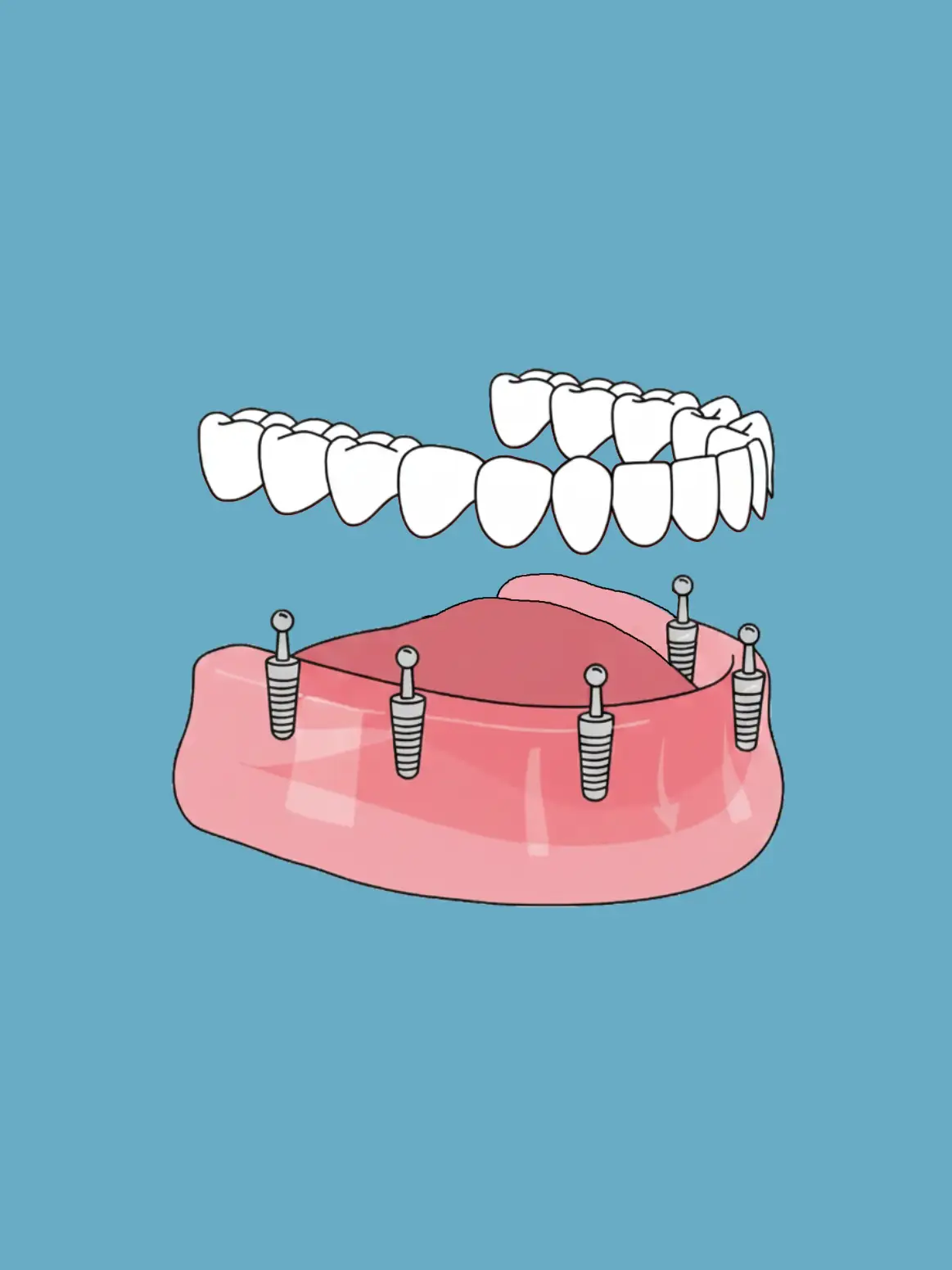 Rehabilitación oral completa
