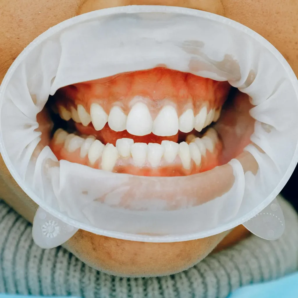 rehabilitacion-oral-masticacion