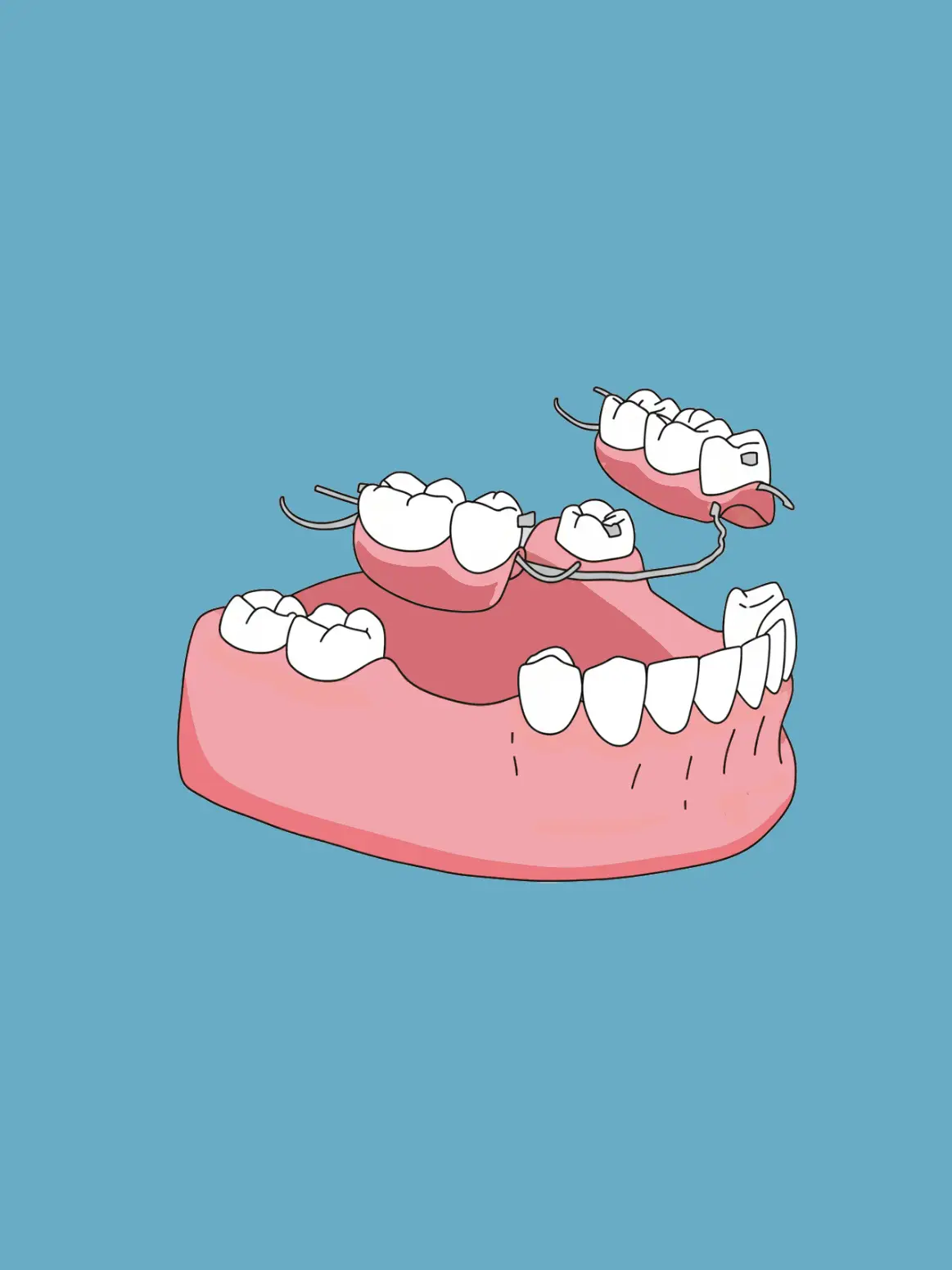 Rehabilitación con prótesis removible