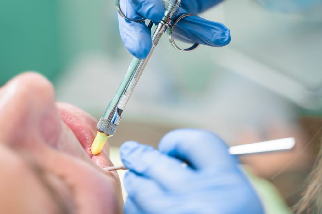 Limpieza y restauracion de conductos dentales por endodoncia